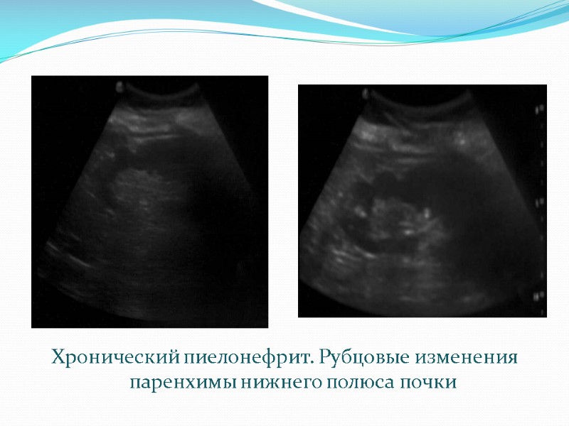 Хронический пиелонефрит. Рубцовые изменения паренхимы нижнего полюса почки